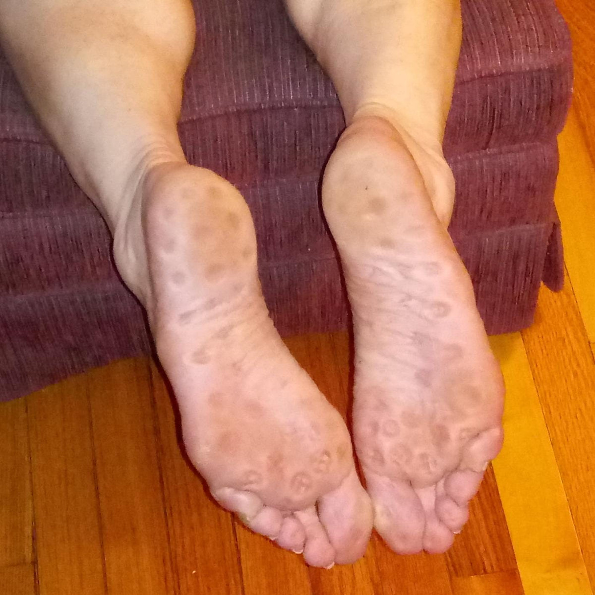 Soles of two bare feet after using the acupressure slippers, showing rounded impressions while resting over a seat edge